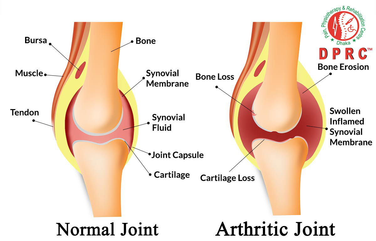 প্রশ্নঃ আথ্রাইটিস রোগের চিকিৎসা ও প্রতিকার কি?