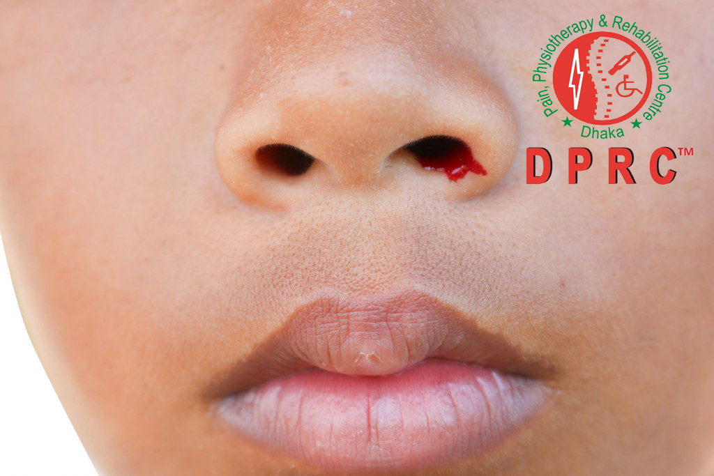 হিমোফিলিয়া