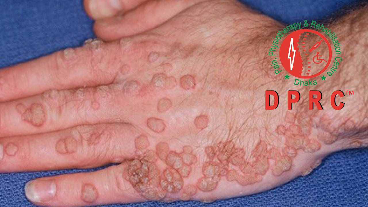 ভাইরাল ওয়ার্টেসের চিকিৎসা