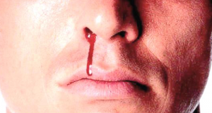 নাক দিয়ে রক্ত পড়লে কি করবেন