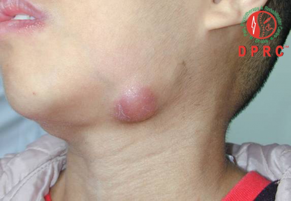 ফুসফুস বহির্ভূত যক্ষ্মা