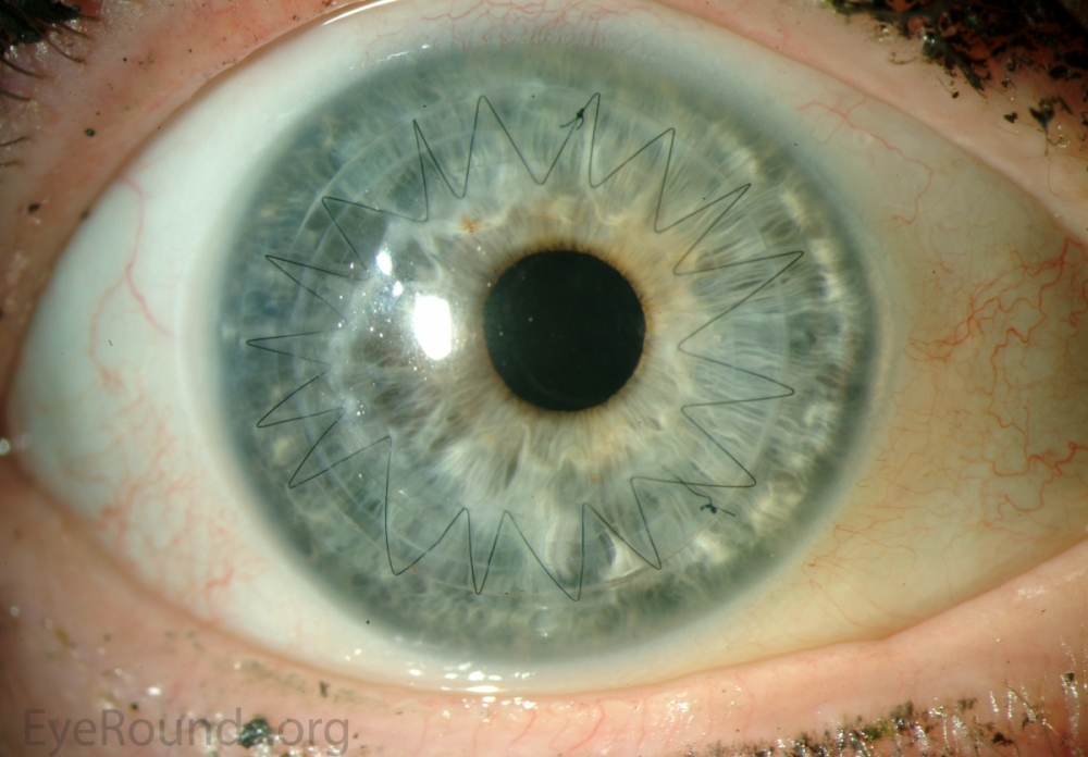 ALK (Keratoplasty Eye Surgery (ALK))
