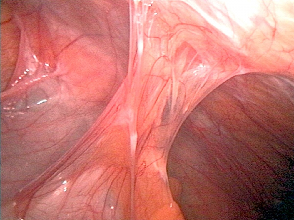 Abdominal Adhesions (Scar Tissue)