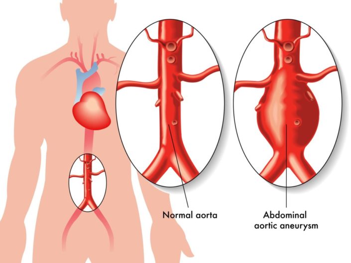 Abdominal Aortic Aneurysm AAA