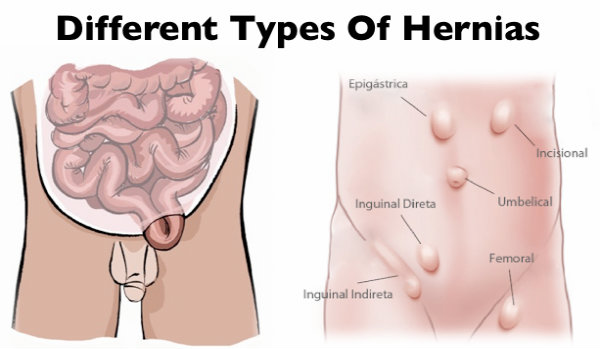 Abdominal Hernia (Hernia Overview)