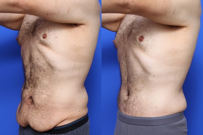 Abdominoplasty (Tummy Tuck ( Abdominoplasty))