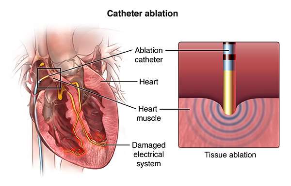 Ablation Therapy for Arrhythmias