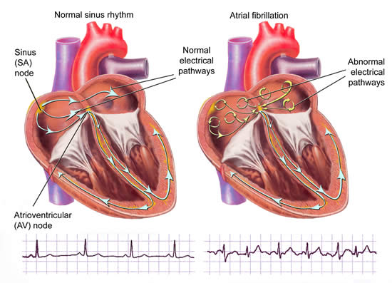 Abnormal Heart Rhythms (Heart Rhythm Disorders)