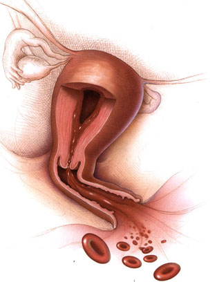 Abnormal Vagnial Bleeding (Vaginal Bleeding)