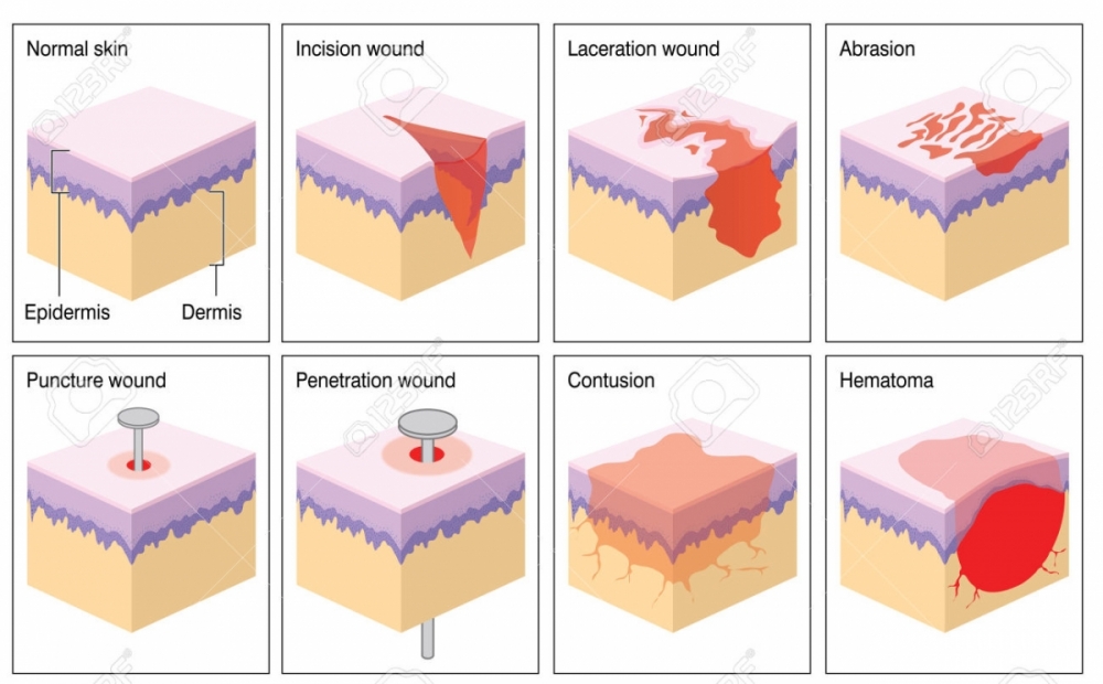 Abrasion