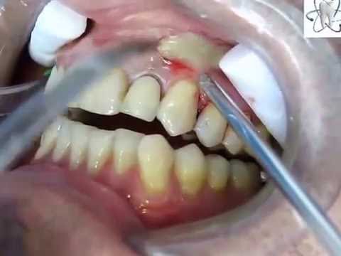 Abscessed Tooth