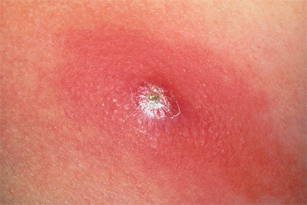Abscesses, Skin (Boils)
