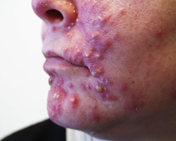 Acne Cystic (Boils)