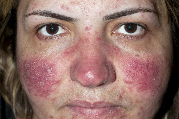 Acne Rosacea (Rosacea)