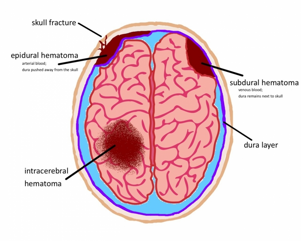 Acquired Brain Injury