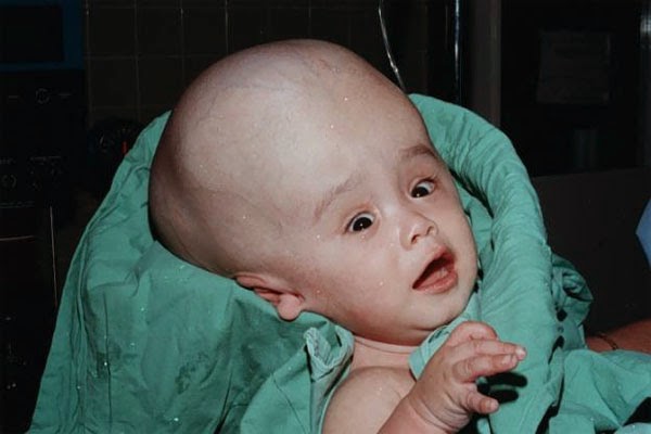 Acquired Hydrocephalus (Hydrocephalus)