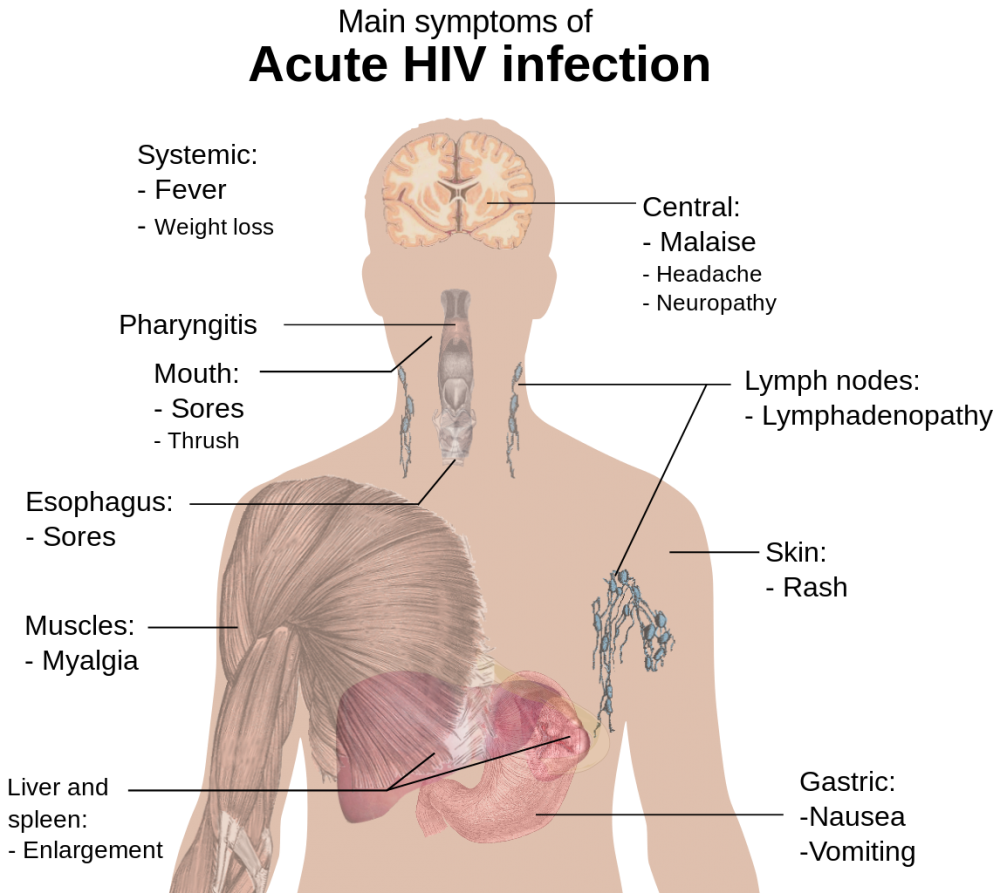 Acquired Immunodeficiency Syndrome (AIDS)