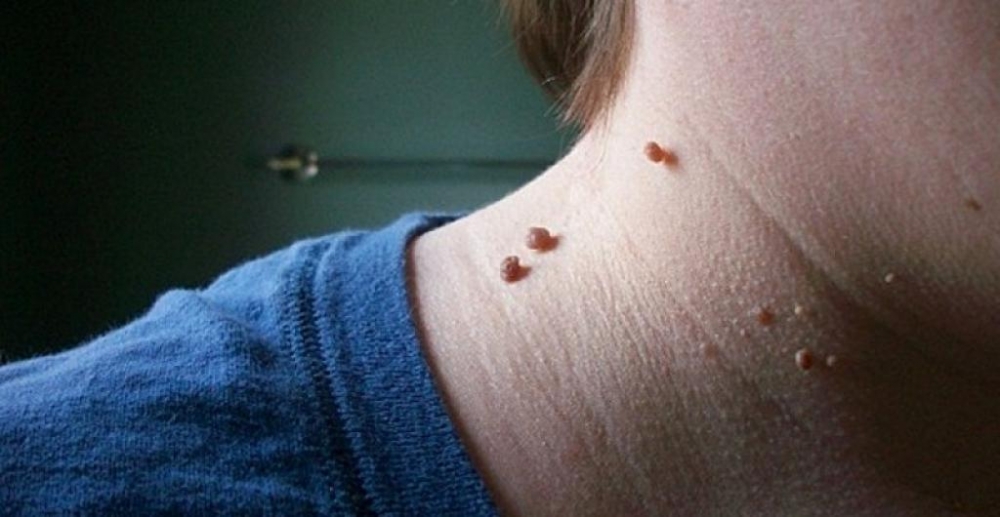 Acrochordon (Skin Tag)