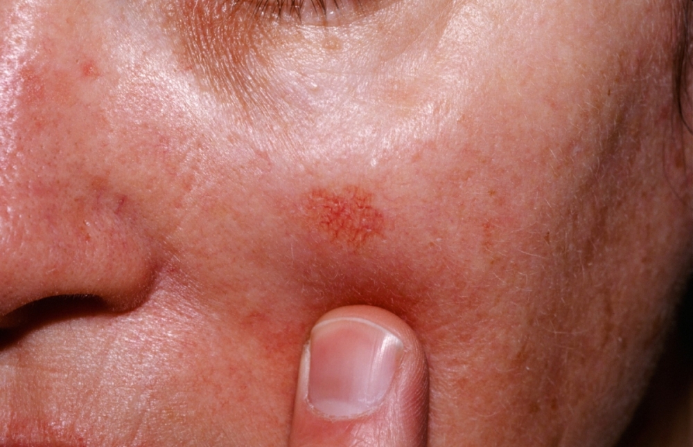 Actinic Keratosis