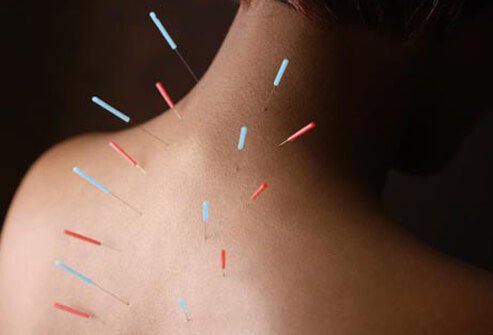 Acupuncture