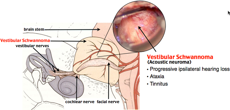 Acustic Neuroma (Vertigo Overview)