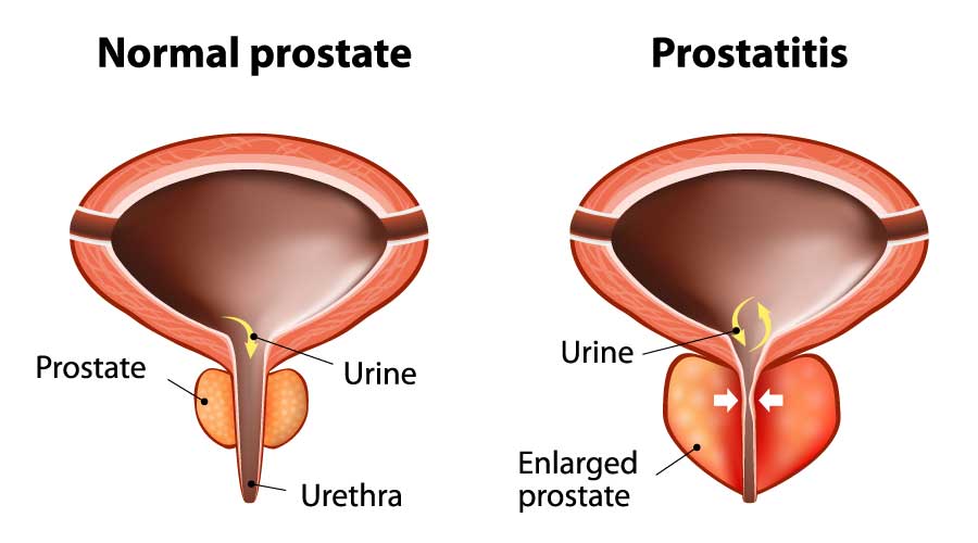 Acute Bacterial Prostatitis (Prostatitis (Inflammation of the Prostate Gland))