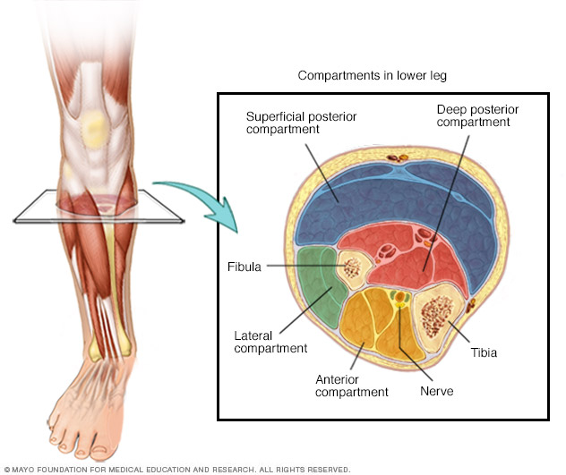 Acute Compartment Syndrome (Compartment Syndrome)