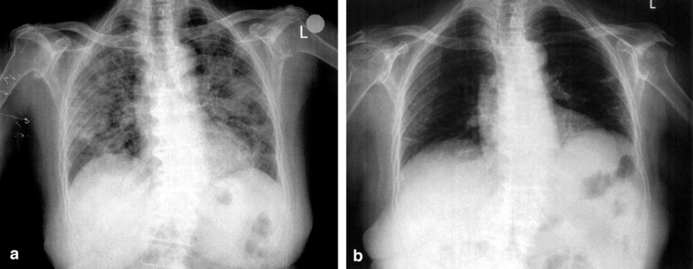 Acute Lung Injury (ARDS)