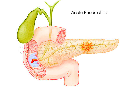 Acute Pancreatitis (Pancreatitis)