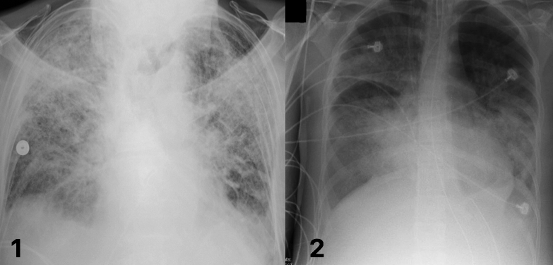 Acute Respiratory Distress Syndrome (ARDS)