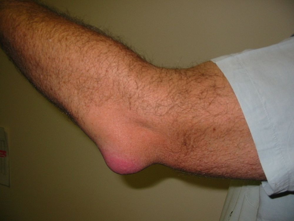 Acute and Chronic Bursitis