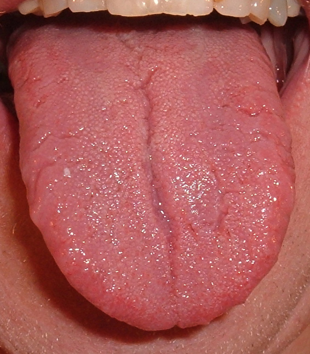Addison Anemia (Pernicious Anemia)