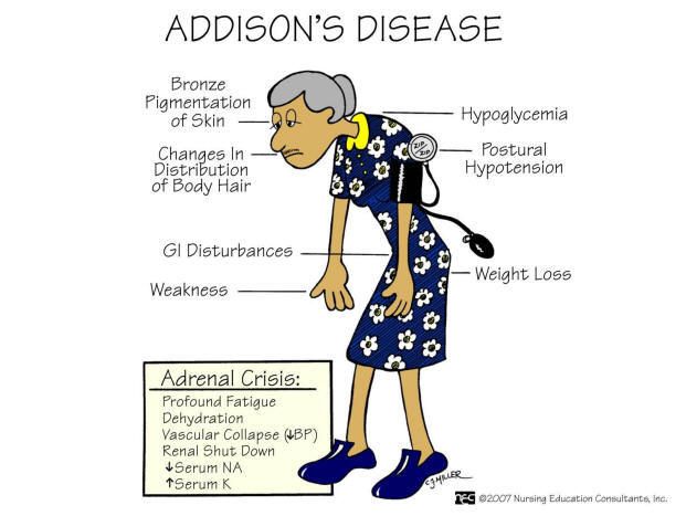 Addison Disease