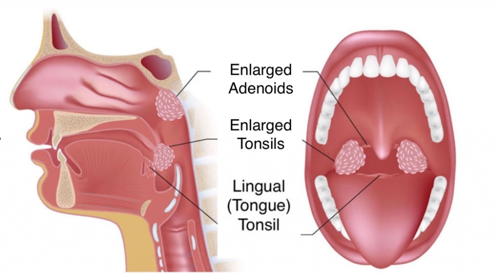Adenoids (Adenoids and Tonsils)