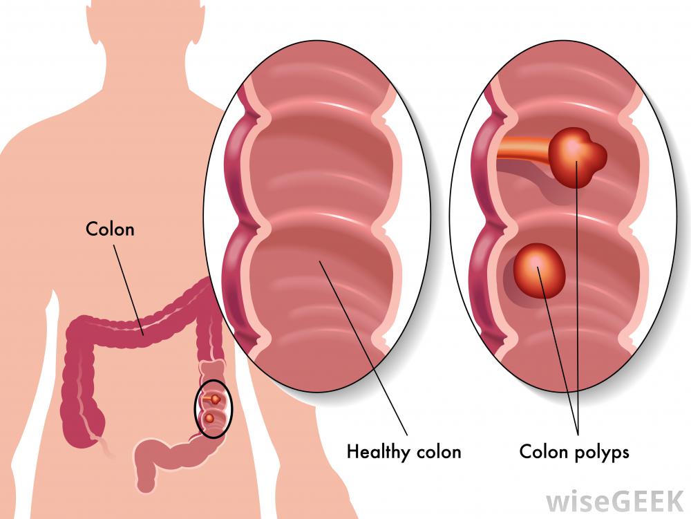 Adenomatous Polyposis Coli (Gardner Syndrome)