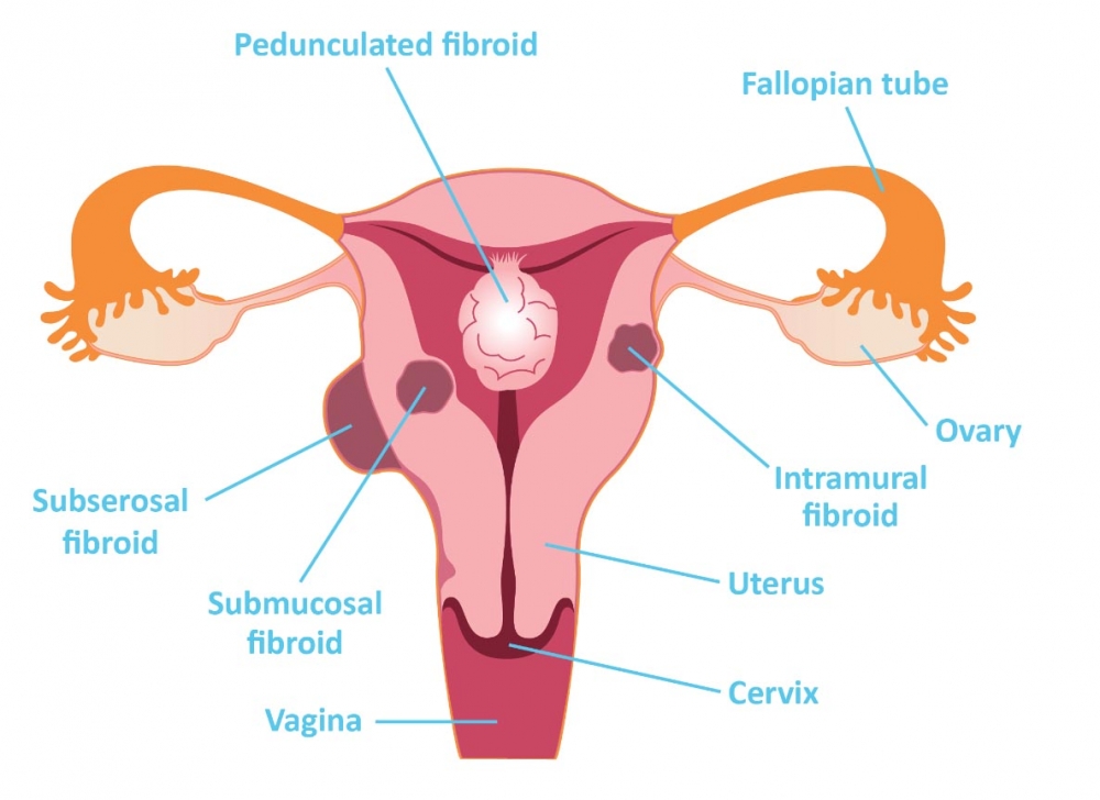 Adenomyosis (Uterine Fibroids)