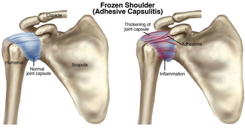Adhesive Capsulitis (Frozen Shoulder)