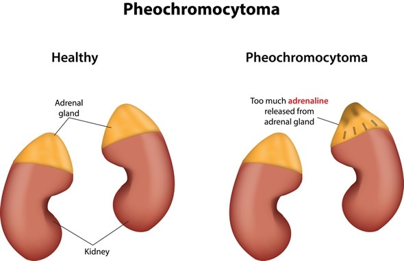 Adrenal Gland Tumor (Pheochromocytoma)