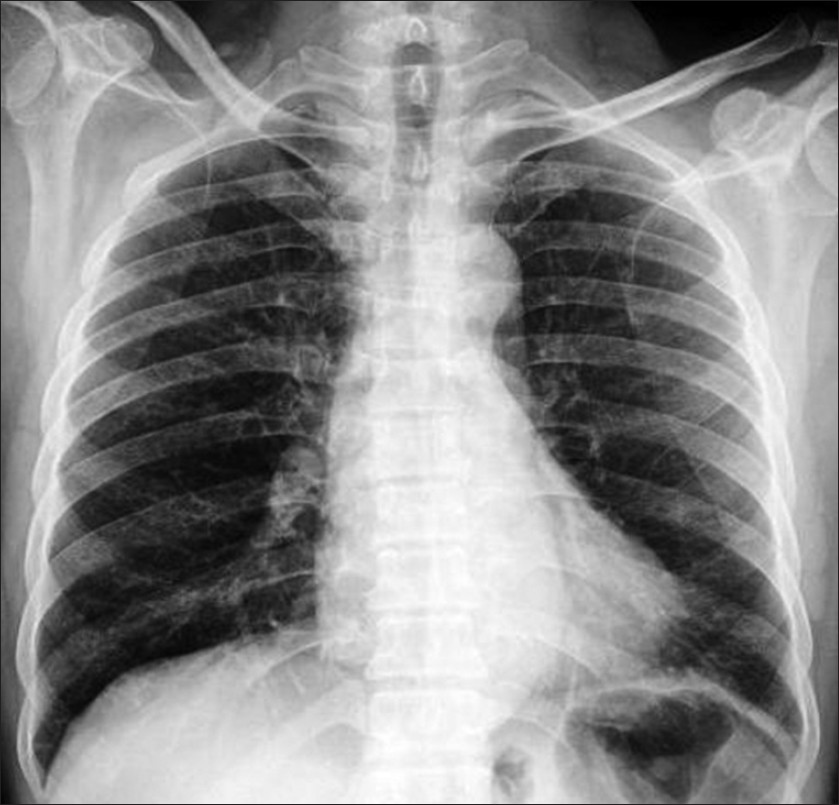 Adult-Onset Asthma