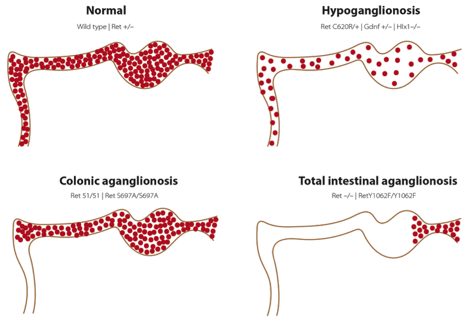 Aganglionosis (Hirschsprung Disease)