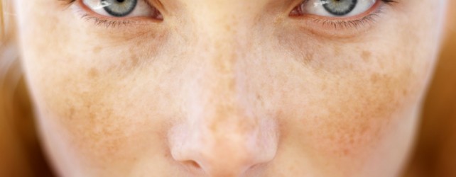 Age Spots (Freckles)