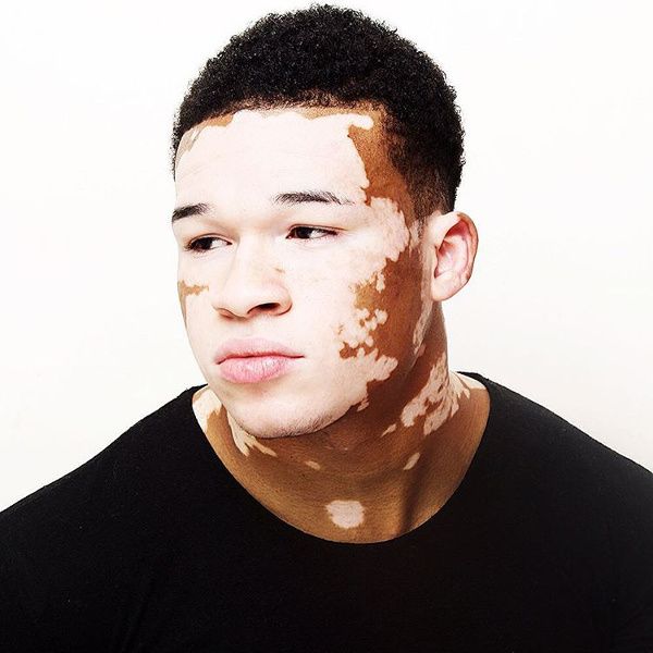 Albinism (Birthmarks and Other Skin Pigmentation Problems)