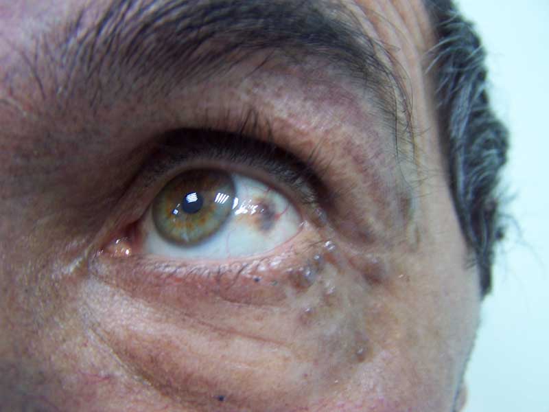 Alcaptonuria (Alkaptonuria)