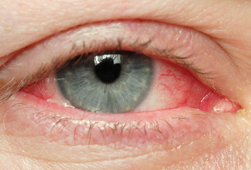 Allergic Conjunctivitis (Pink Eye)