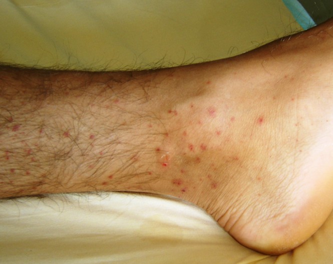 Allergic Granulomatosis And Angiitis (Churg-Strauss Syndrome)