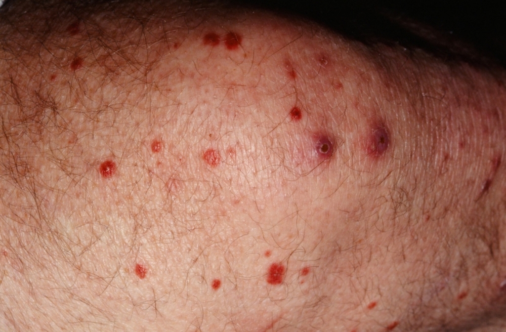 Allergic Purpura (Henoch-Schonlein Purpura)