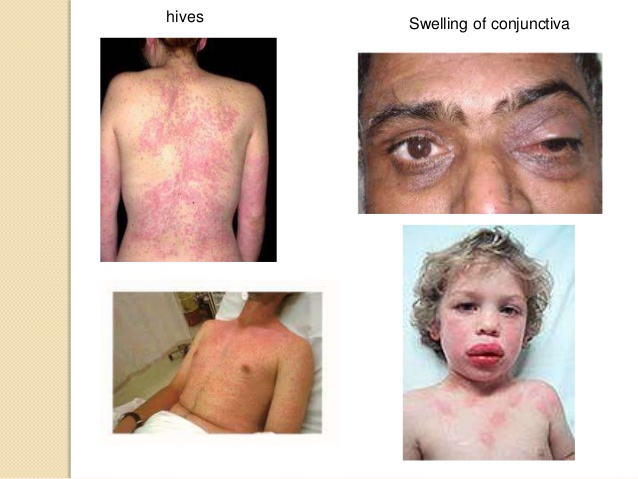 Allergic Reaction (Anaphylaxis)