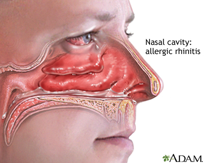 Allergic Rhinitis (Allergy)