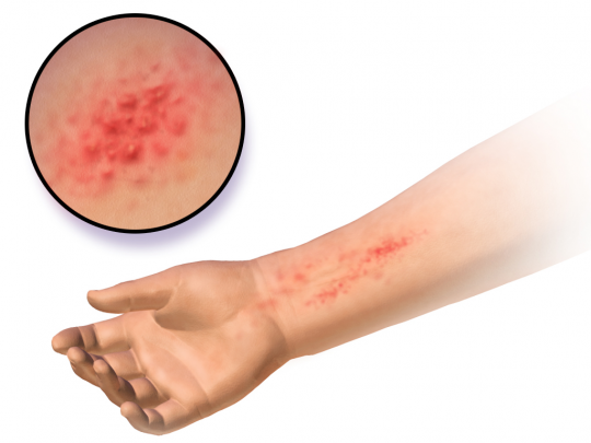 Allergy, Latex (Latex Allergy)