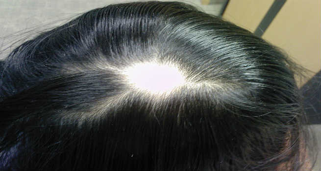 Alopecia Areata